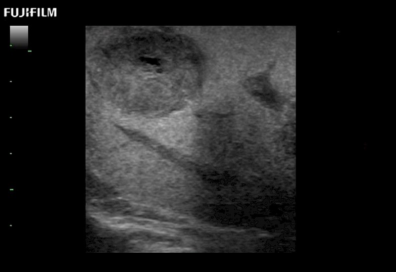 Liver Moderate Hepatocellular Disease