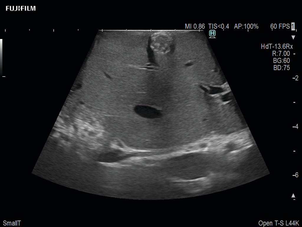 Liver Ablation Procedure using L44K
