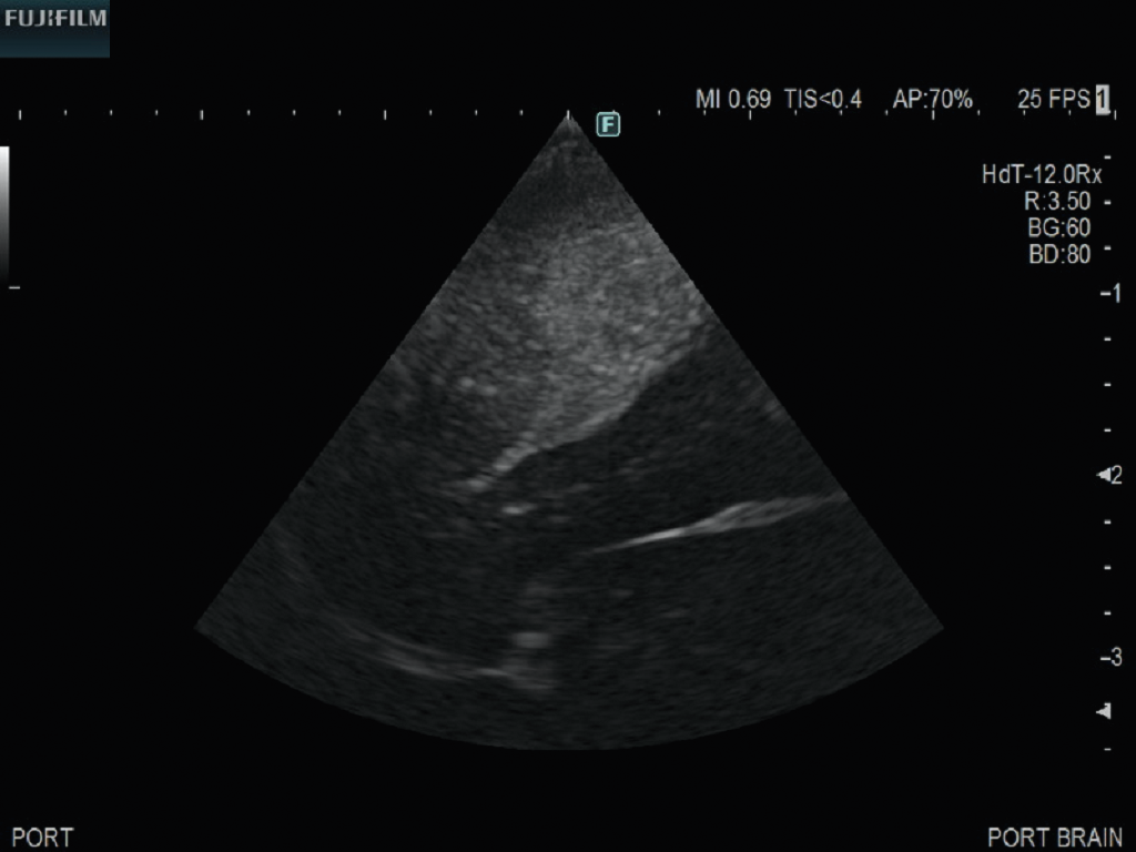 Subcortical Procedure using S12BP4