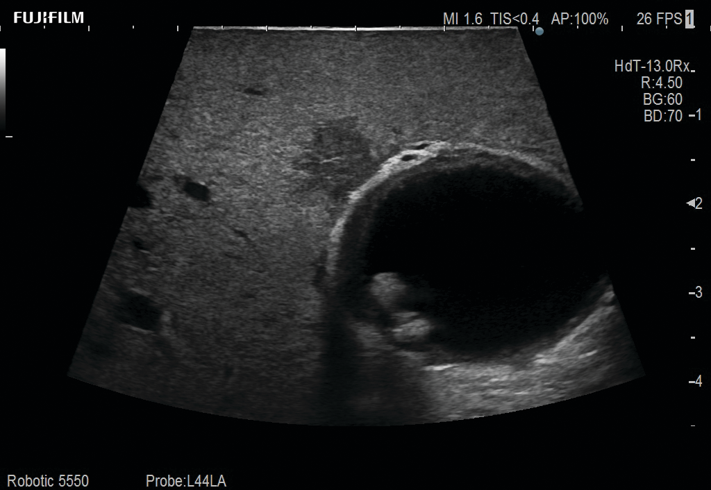 Laparoscopic Cholecystectomy and Hepatectomy using L44LA