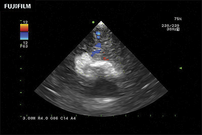 Subcortical Procedure using S12BP4
