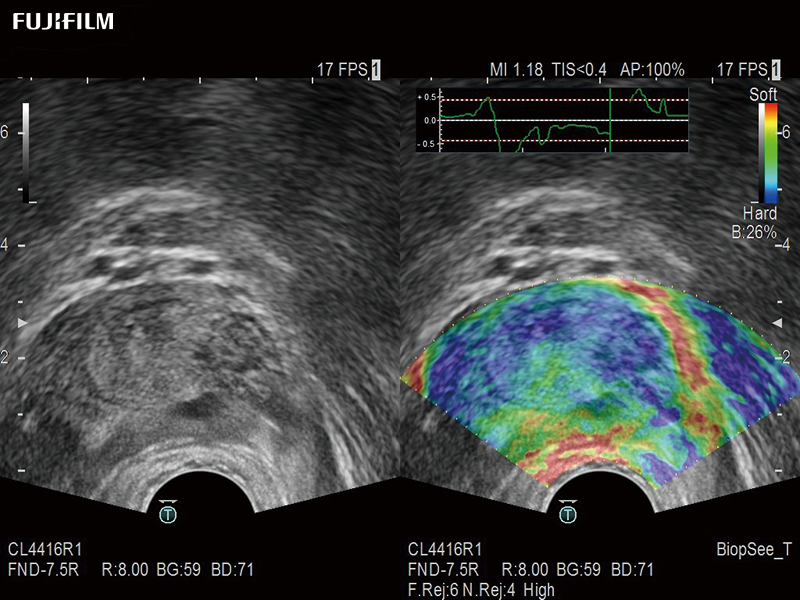 Prostate Imaging using the CL4416R1Transducer